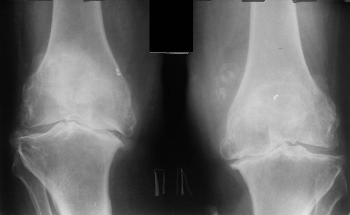 radiographie des articulations du genou avec arthrose