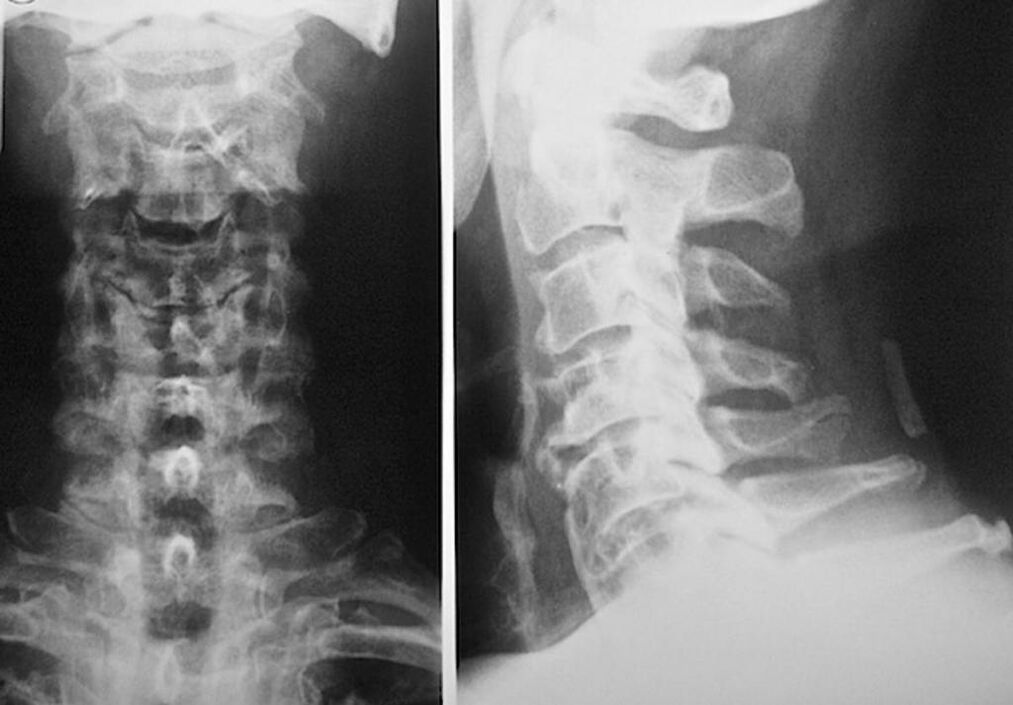 radiographie de la colonne cervicale avec ostéochondrose