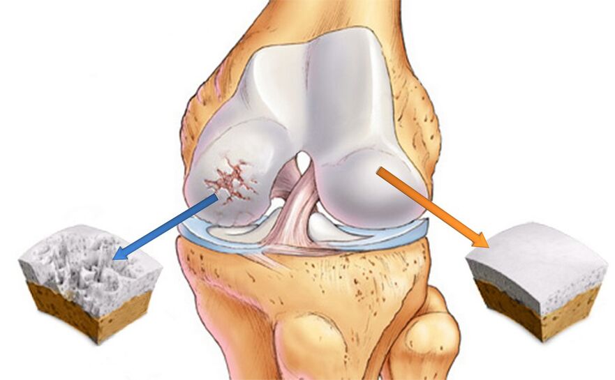 Arthrose de l'articulation du genou