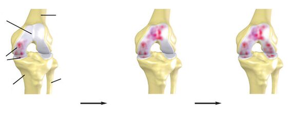 Le degré d'arthrose de l'articulation du genou