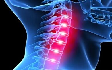 Symptômes de l'ostéochondrose de la colonne cervicale