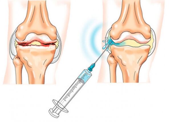 injections intra-articulaires pour l'arthrose du genou