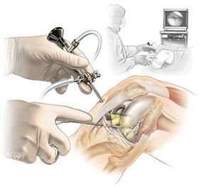Clarification du diagnostic de l'arthrose de la médecine du tableau de bord
