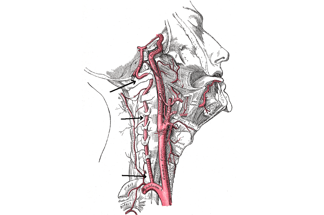 compression de l'artère vertébrale avec ostéochondrose cervicale