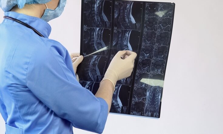 Le diagnostic « d’ostéochondrose cervicale » est posé sur la base d’une étude IRM