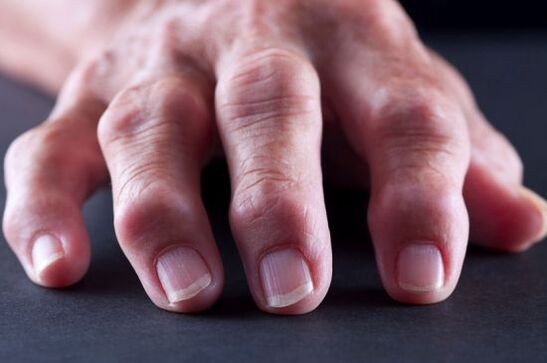 Déformations articulaires des doigts dues à l'arthrose ou à l'arthrite